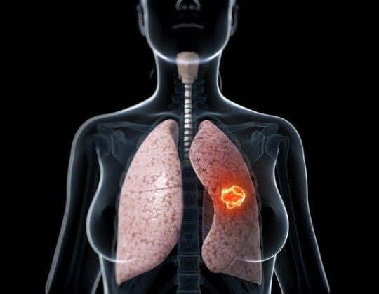 Dấu hiệu ung thư phổi giai đoạn đầu và những phương pháp chẩn đoán, điều trị phổ biến nhất hiện nay