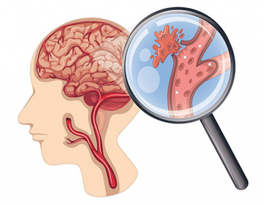 Các di chứng sau tai biến mạch máu não có thể gặp? Biện pháp phục hồi sau tai biến