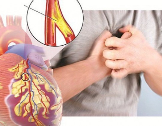 Xơ vữa động mạch là gì? Triệu chứng và cách điều trị như thế nào?