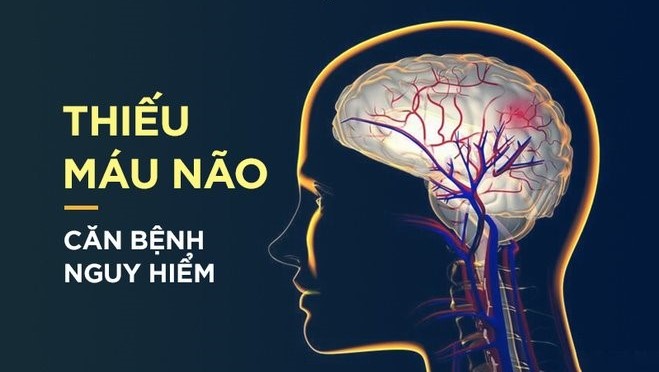 bệnh thiếu máu não là căn bệnh nguy hiểm