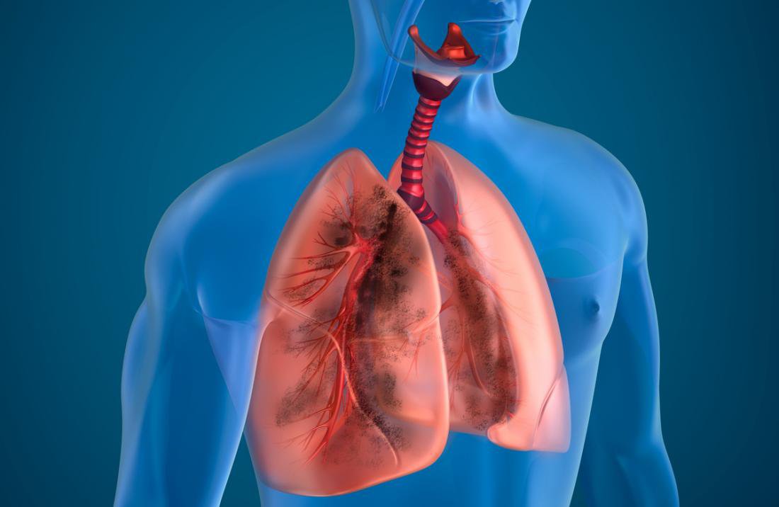 Tắc nghẽn phổi có thể xảy ra khi cục máu đông xuất hiện và phát triển ở các động mạch cung cấp máu cho phổi