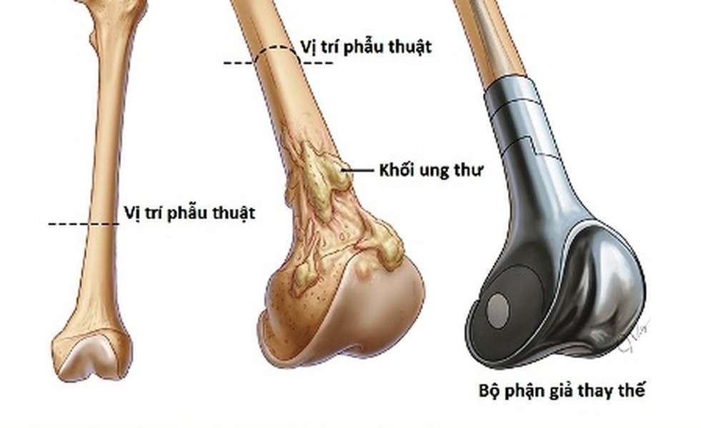 điều trị ung thư xương hiệu quả