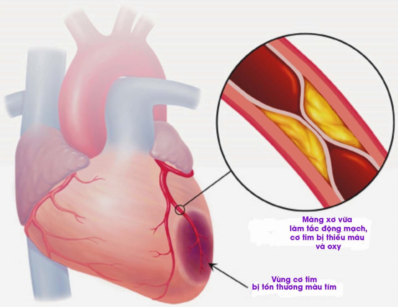 Hình ảnh nhồi amus cơ tim do mỡ máu cao