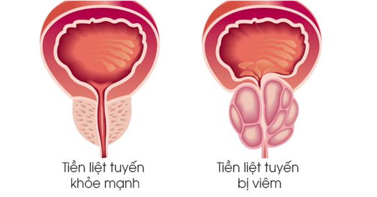 Viêm tuyến tiền liệt ở nam giới không chỉ ảnh hưởng nhiều đến tiểu tiện mà còn tác động rất nhiều đến khả năng sinh sản của nam giới