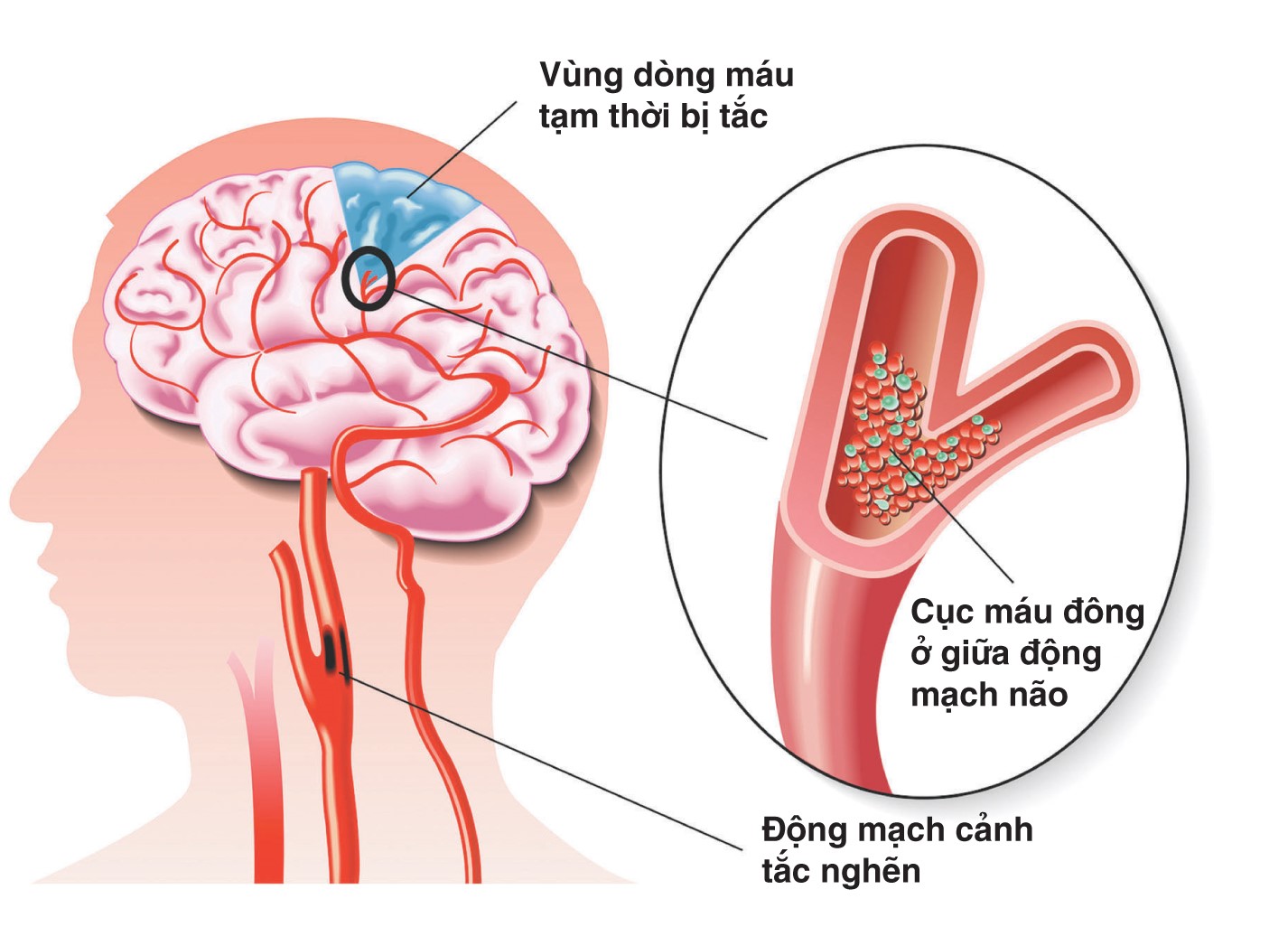 Viên uống bổ não cho người tai biến - Bệnh lý mạch máu nhỏ do cao huyết áp