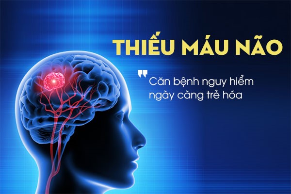  Thiếu máu não ngày càng bị trẻ hóa